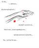 Phantom Hallucination
